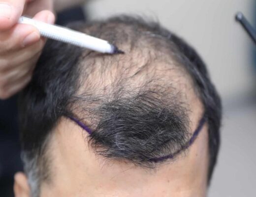 hair transplant cost Turkey,