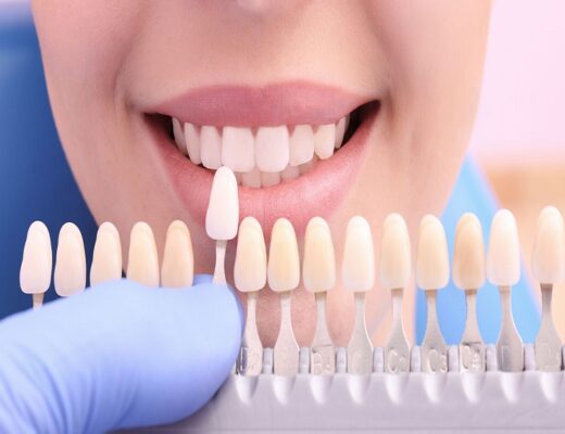 Lumineers veneers in San Francisco