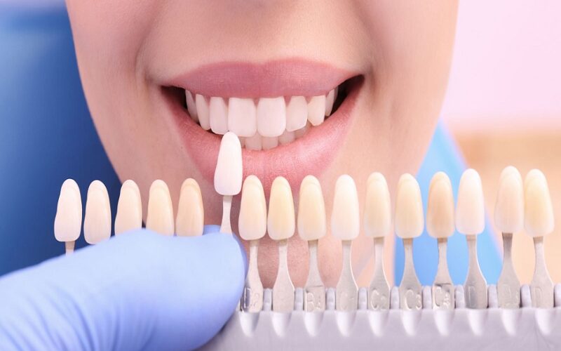 Lumineers veneers in San Francisco